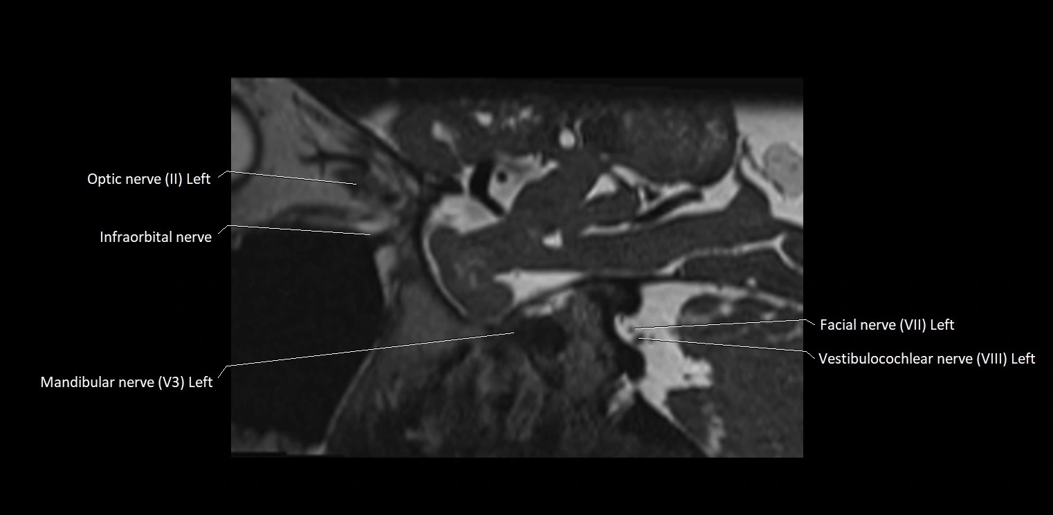 Cranial nerve sagittal anatomy MRI 3T image 15.webp